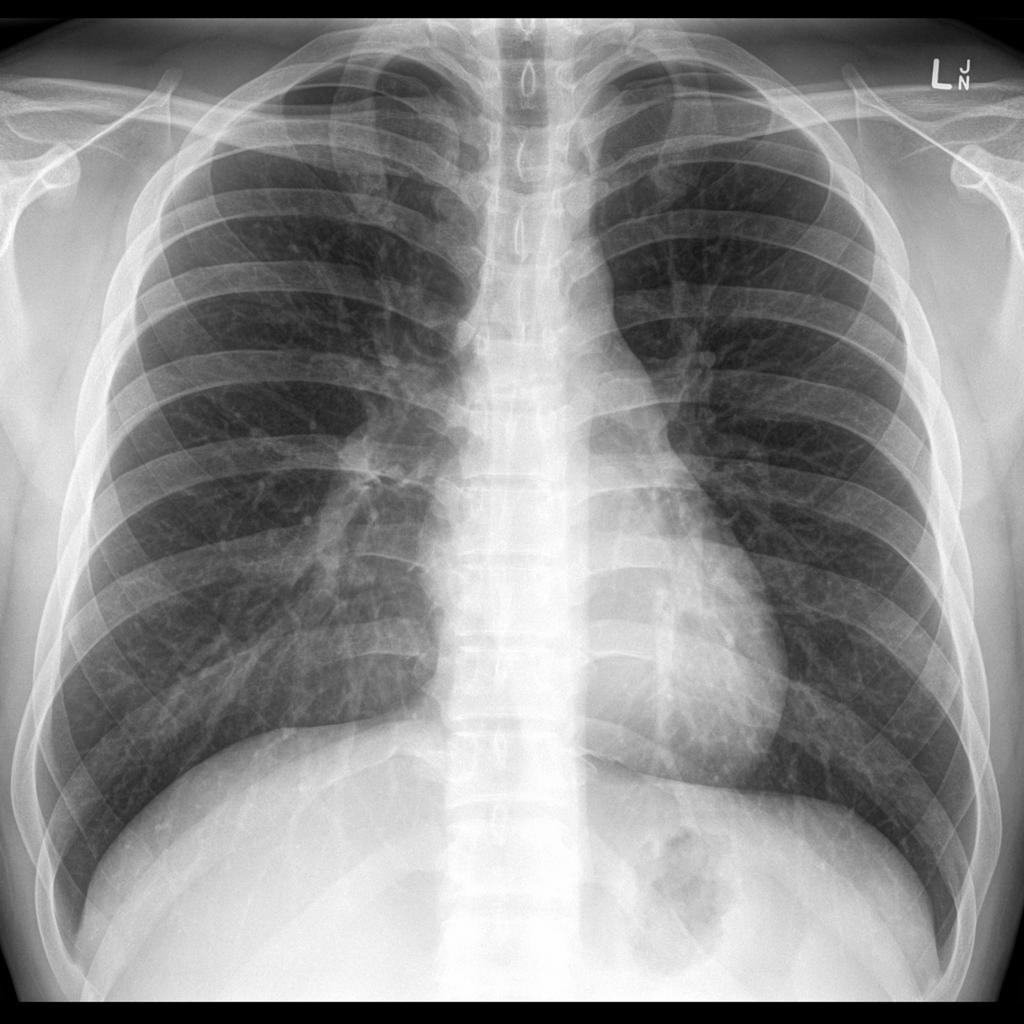 рентгенограмма легких