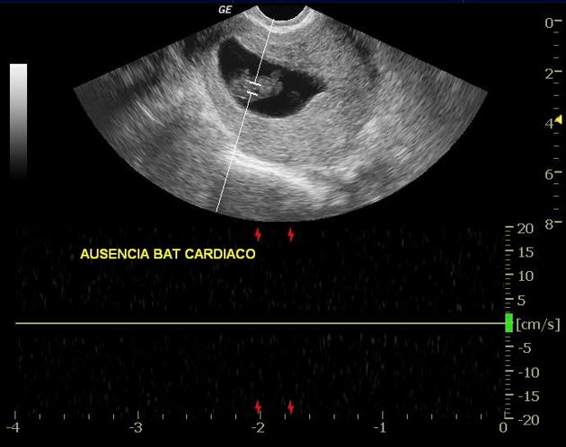 замершая беременность на УЗИ