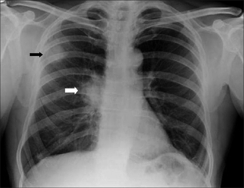 рентгенограмма рака бронха