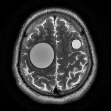МРТ эхинококкоза головного мозга
