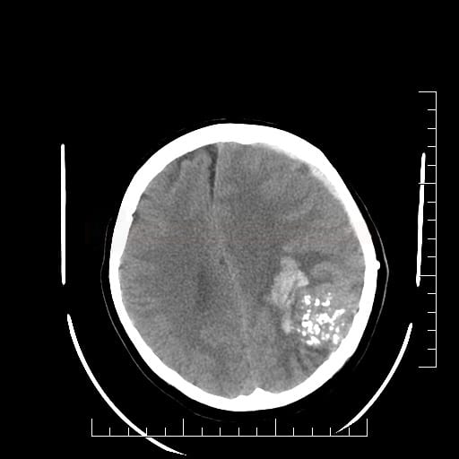 КТ венозной мальформации головного мозга