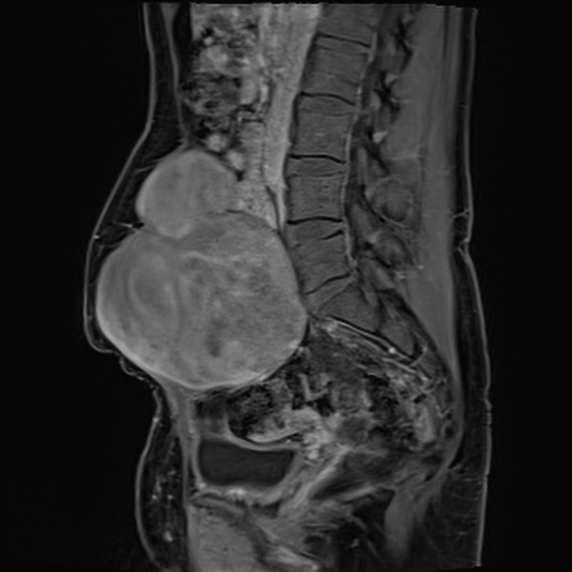 МРТ десмоидной опухоли