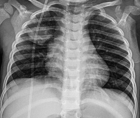 рентген очаговой пневмонии