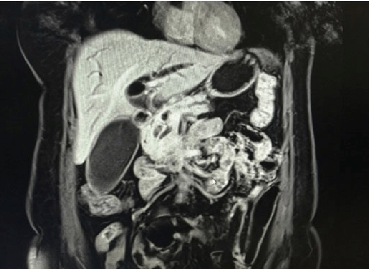 МРТ водянки желчного пузыря