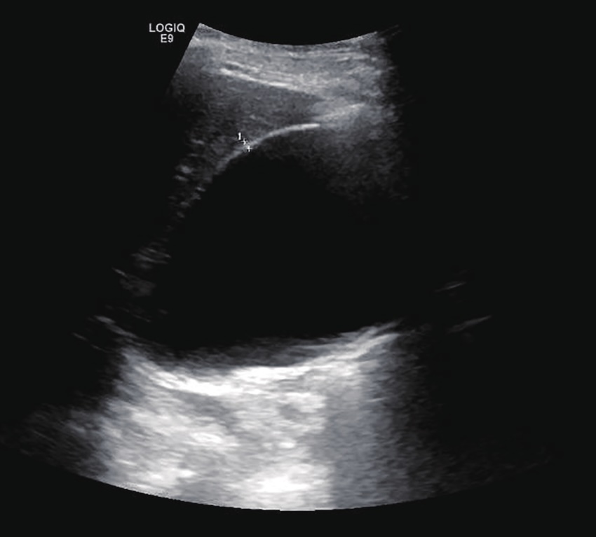 УЗИ водянки желчного пузыря