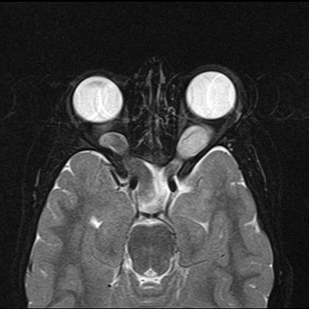 МРТ глиомы хиазмы
