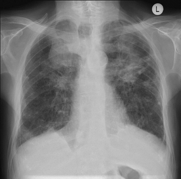 рентген пневмокониоза