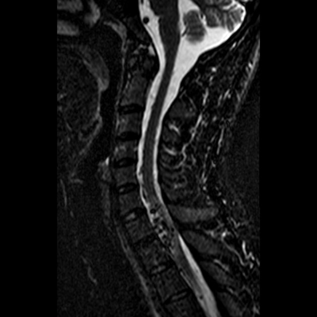 МРТ артериовенозных мальформаций спинного мозга