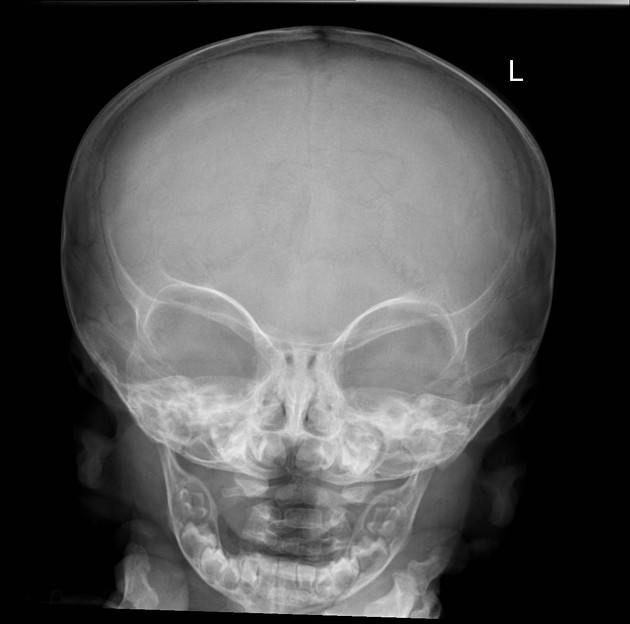 рентген синостоза черепа
