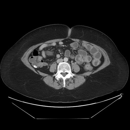 гастриномы на КТ