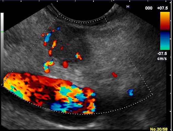 гастринома на УЗИ