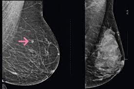 маммограмма рак молочных желез