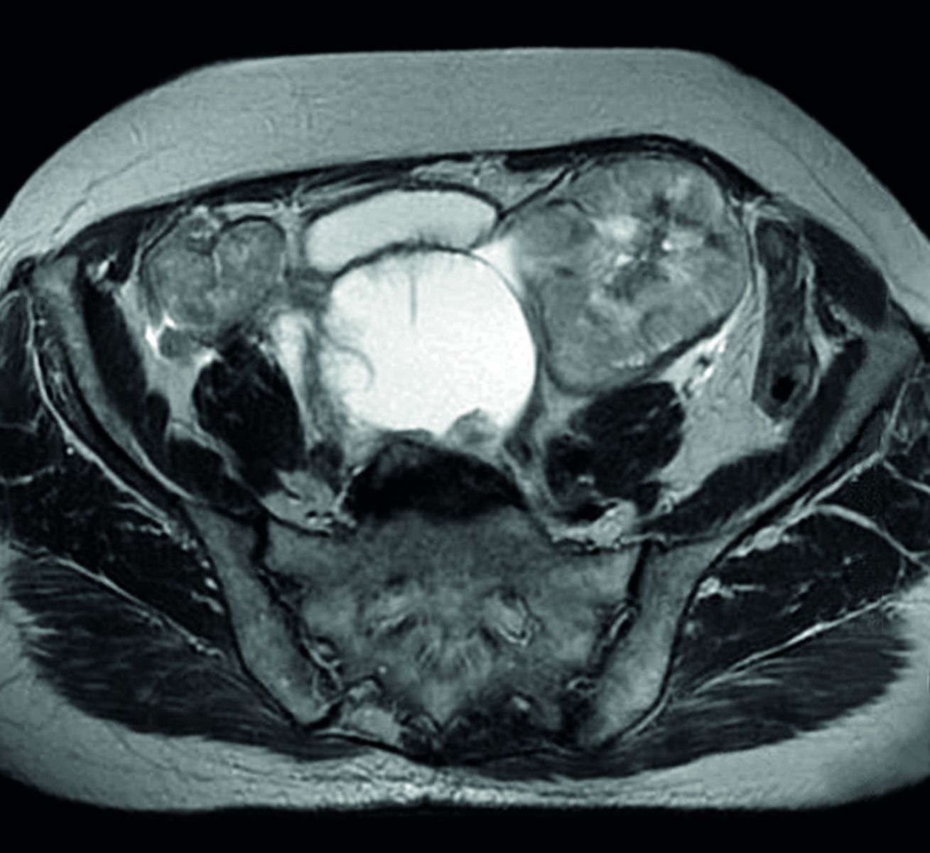 киста яичника на МРТ фото