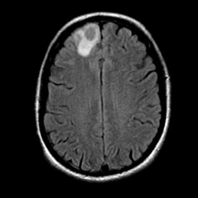 абсцесс головного мозга МРТ фото