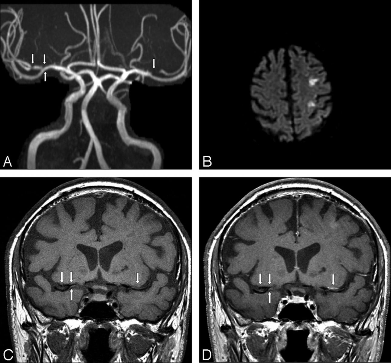 МРТ фото атеросклероз головного мозга