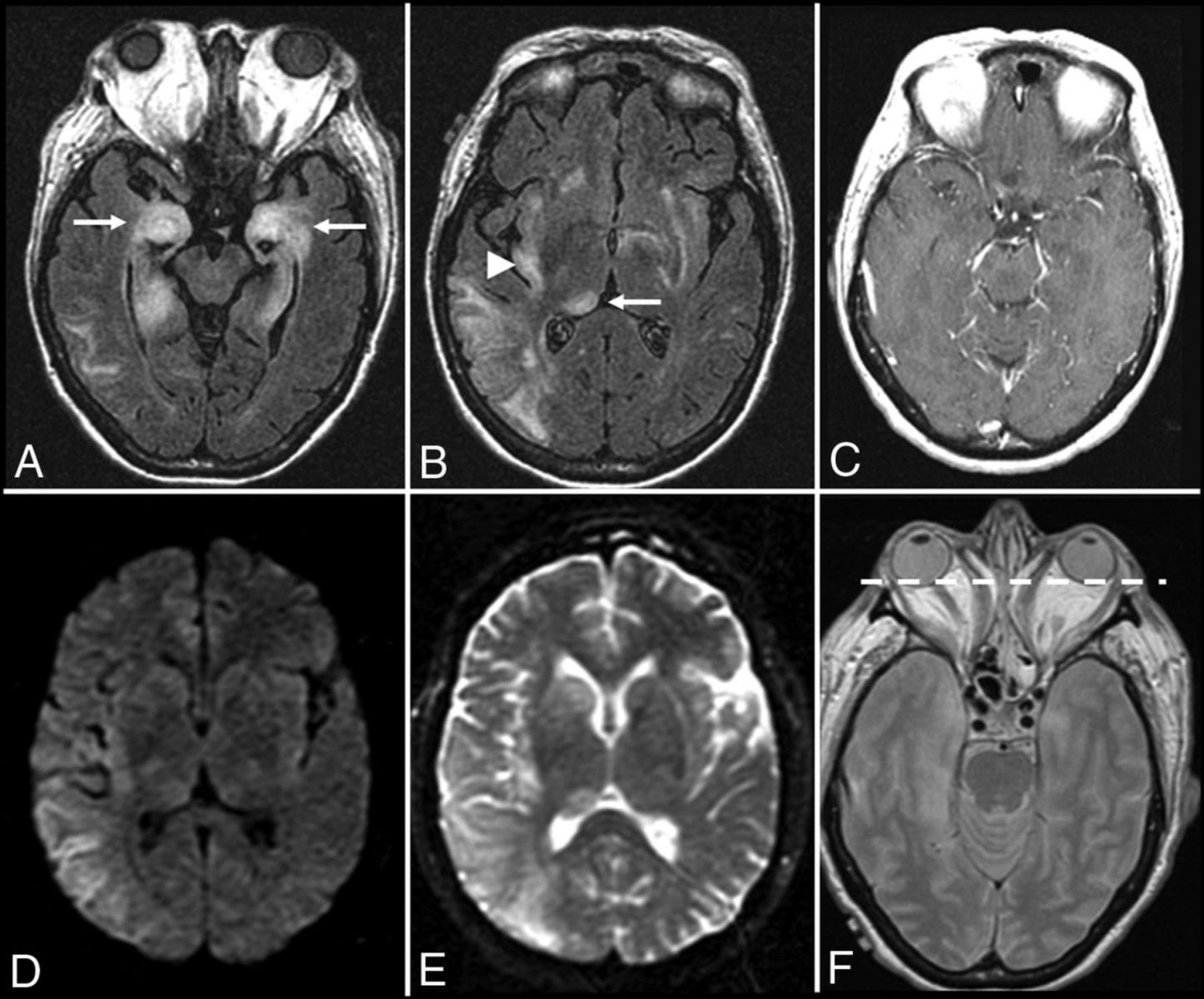 МРТ фото энцефалит мозга