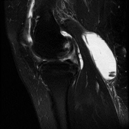 МРТ фото киста колена
