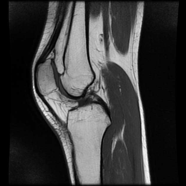МРТ фото саркома мягких тканей колена