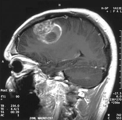 опухоль мозга на МРТ фото