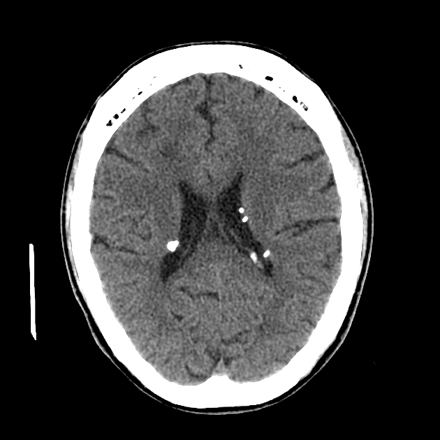 МСКТ туберозного склероза