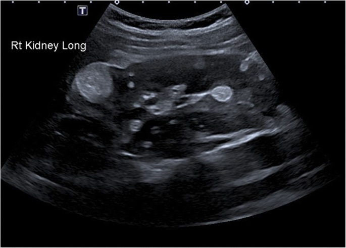 УЗИ туберозного склероза