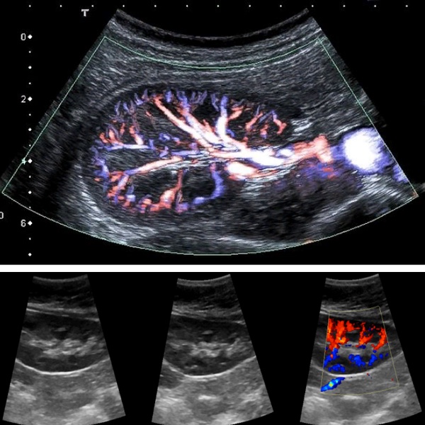 УЗИ стеноз почечных артерий