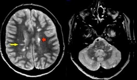 очаги рассеянного склероза на МРТ снимках головного мозга