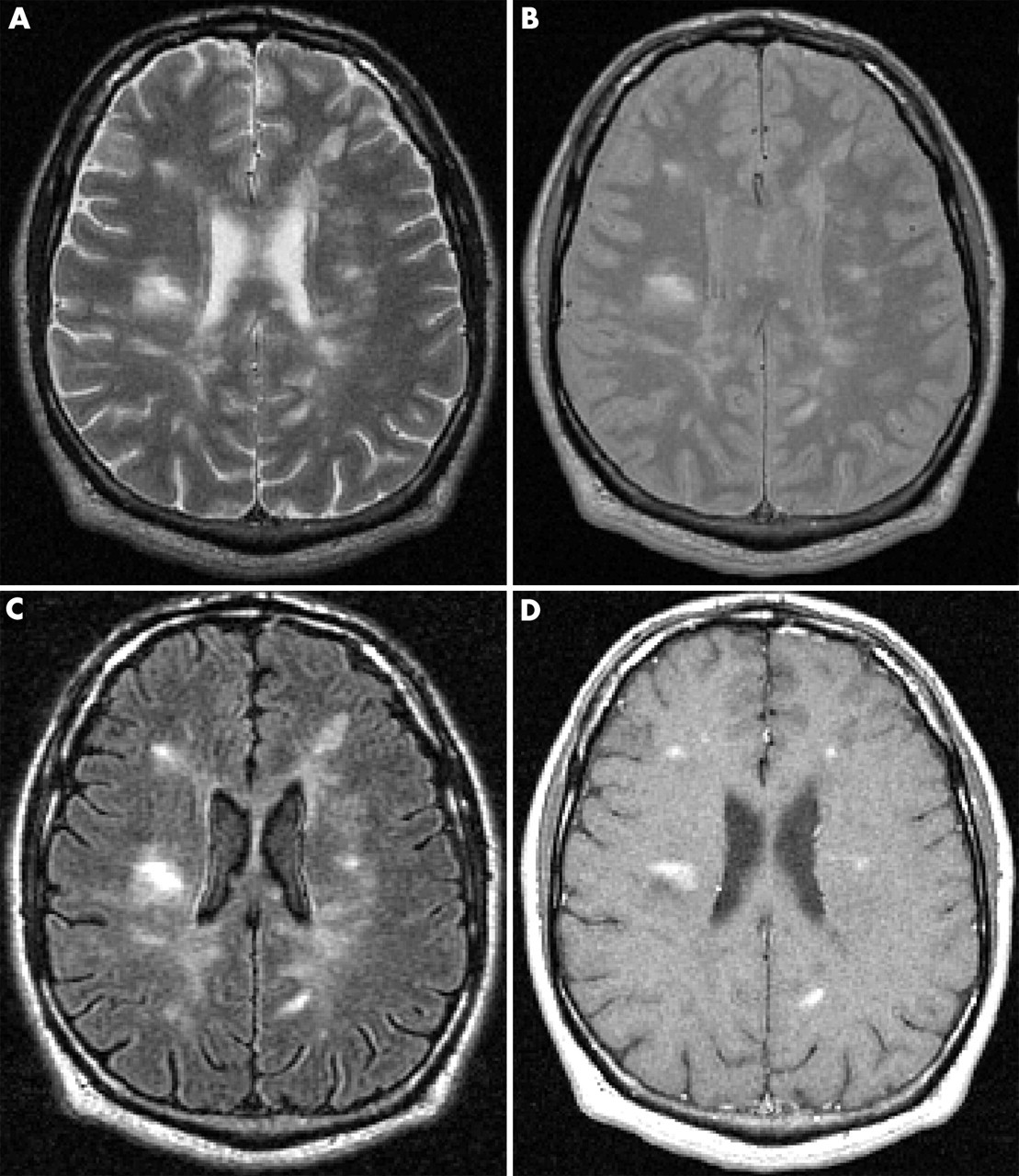 признаки РС на МРТ головного мозга