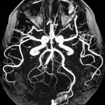 снимок МРТ сосудов головного мозга