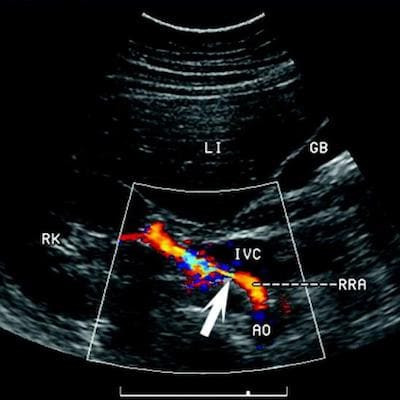 узи или мрт головы. что такое кт мрт и узи, отличия. ультразвуковая допплерография сосудов шеи. узи транскраниальных сосудов. допплерография сосудов головного мозга.