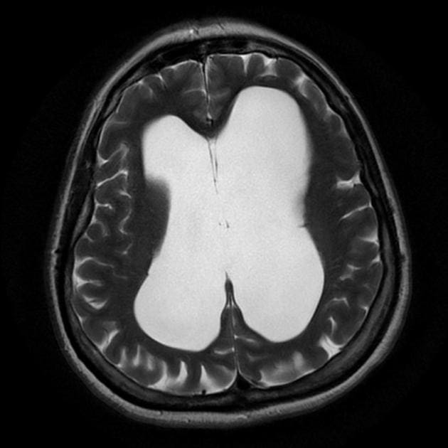 гидроцефалия головного мозга на МРТ