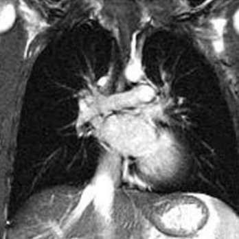 снимок МРТ органов грудной полости