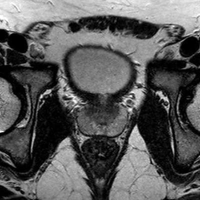 снимок МРТ органов малого таза у мужчин