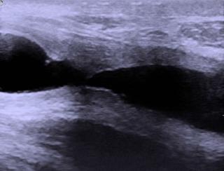 Стриктуры уретры на УЗИ