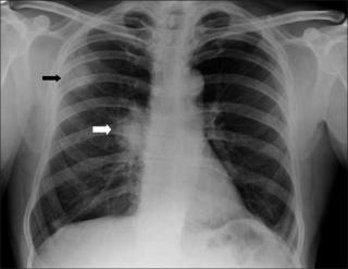 Рак бронха на рентгене