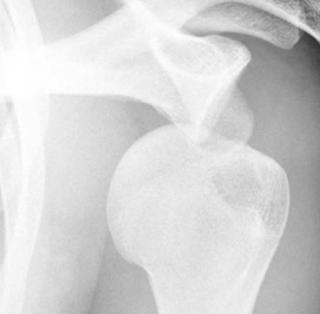 Рентген в диагностике привычного вывиха