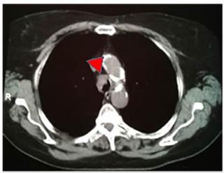 Рак трахеи на МСКТ