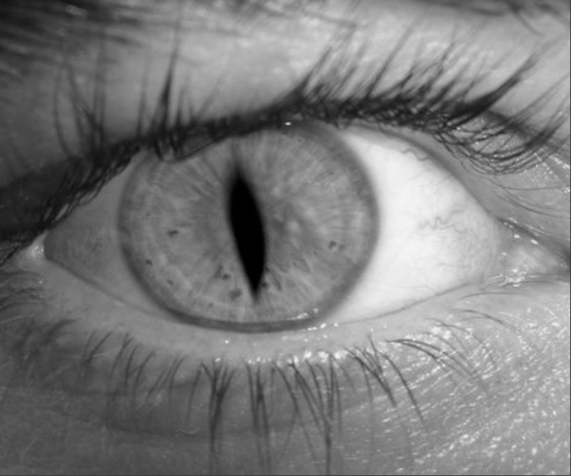 Синдром кошачьего глаза - симптомы, признаки, протокол обследования