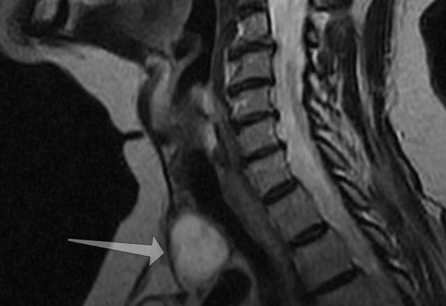 Рак щитовидной железы на МРТ - что покажет