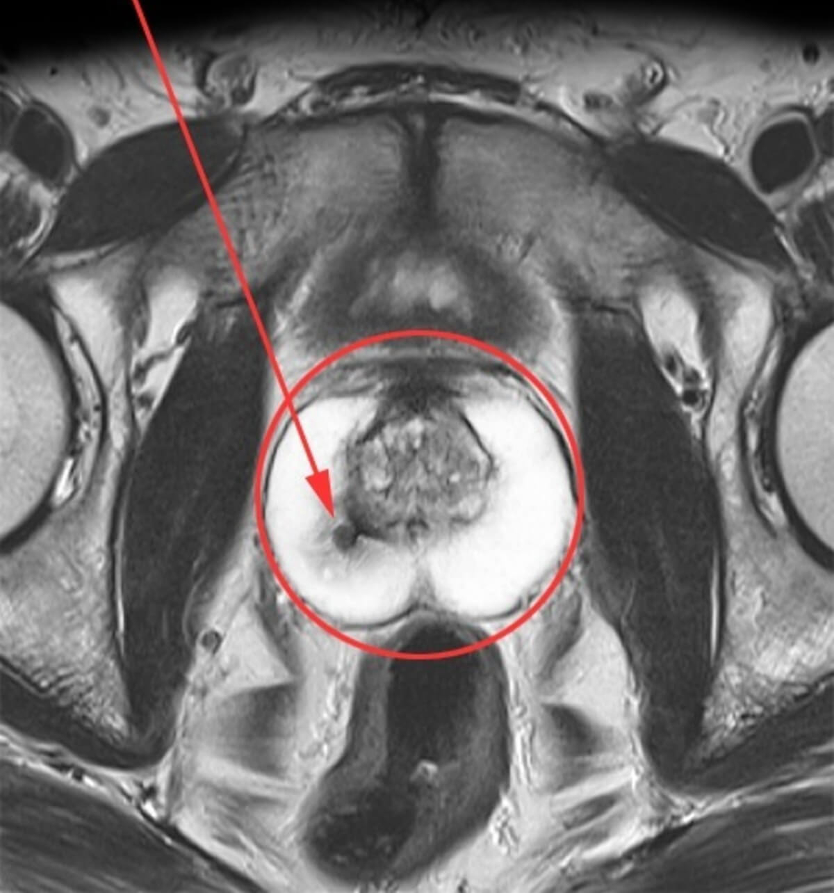 Мрт простаты мрт фото